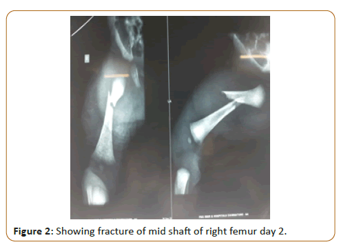 pediatric-care-femur