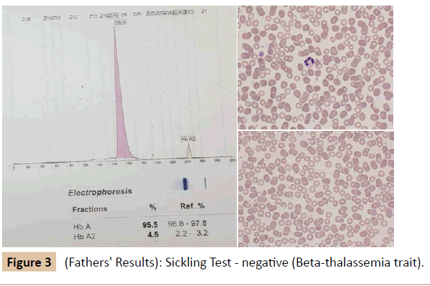 pediatrics-Beta-thalassemia-trait