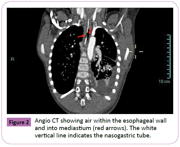 pediatrics-Lithium-vertical-indicates-nasogastric