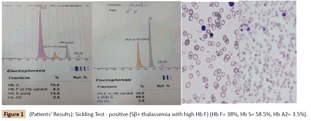 pediatrics-Sickling-Test-positive