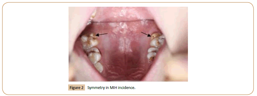 pediatrics-Symmetry-MIH-incidence