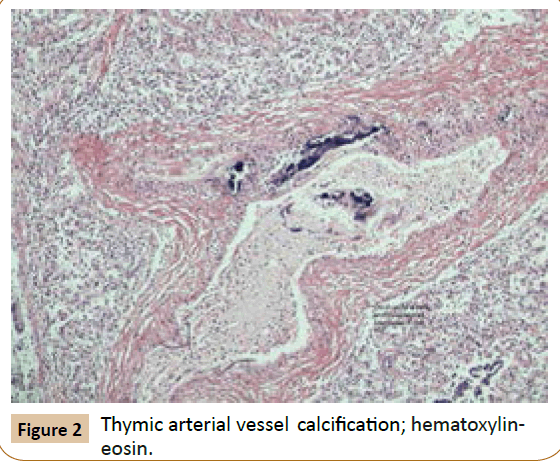 pediatrics-Thymic-arterial-vessel