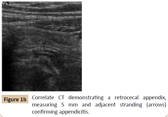 pediatrics-retrocecal-appendix-measuring